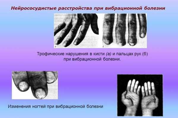 Реферат: Вибрационная болезнь от действия локальной вибрации III ст., сенсомоторная полинейропатия рук со стойкими нейротрофическими нарушениями на кистях, нейросенсорная тугоухость III ст.