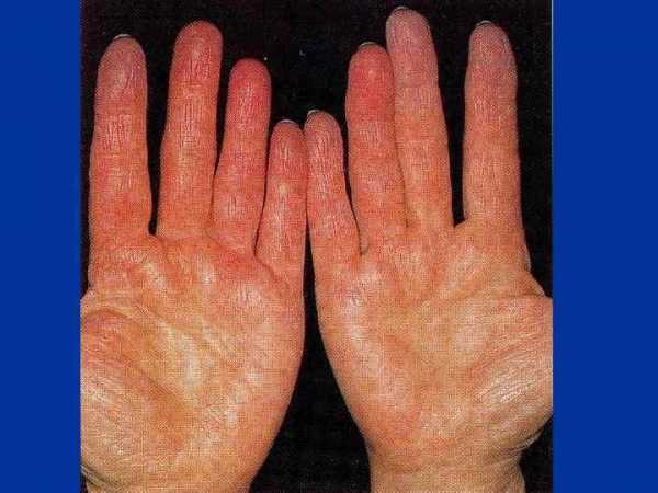 Реферат: Вибрационная болезнь от действия локальной вибрации III ст., сенсомоторная полинейропатия рук со стойкими нейротрофическими нарушениями на кистях, нейросенсорная тугоухость III ст.